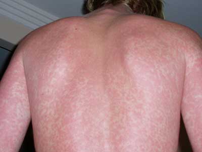 HIV-Rash-4.jpg