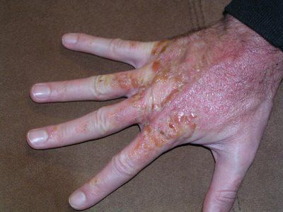 poison-oak3.jpg