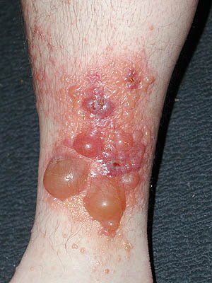 poison-oak4.jpg