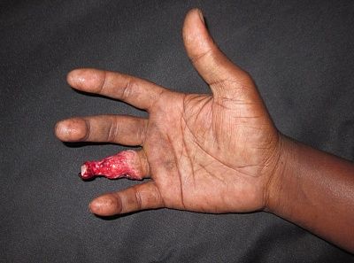 crushed-20finger-20-281-29.jpg