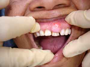 dental-abscess-causes-symptoms-treatment-and-prevention-1.jpg