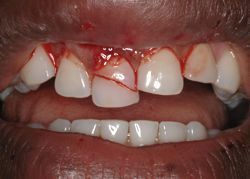 tooth_trauma.jpg