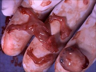 abortion.jpg