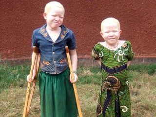 abc_albinism_5_090914_mn.jpg