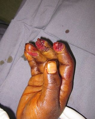 fingertips-20ripped-20off-20-282-29.jpg