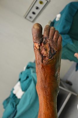 foot-20infection-20-281-29.jpg