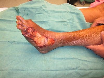 diabetic-20foot-20-281-29.jpg