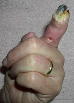 severe-finger-ulceration-by-kathy-baker.jpg