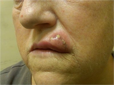 facial-20wound.jpg