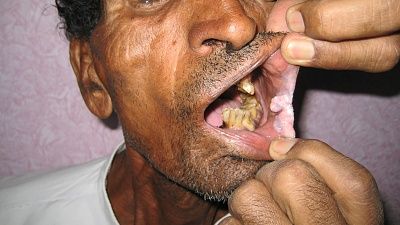 mouth-20cancer-20lip-20defect-20-281-29.jpg