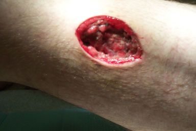 Name:  brown-recluse-leg-bite.jpeg
Views: 31550
Size:  15.9 KB