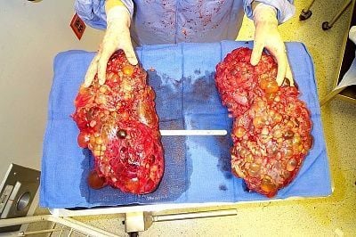 dads_kidneys.jpg