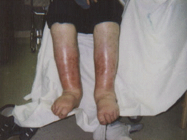 lymphedema_image013.gif