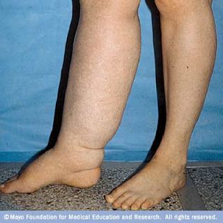 r7_lymphedema.jpg