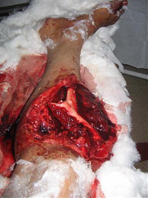 leg-fracture.jpg