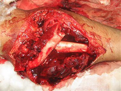 leg fracture 1.jpg
