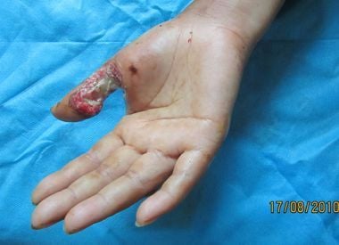 electrical%20shock%20injury.jpg