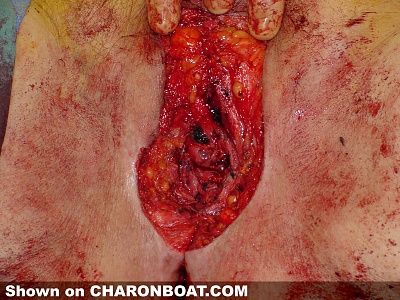 charonboat_dot_com_cancer_vulva2.jpg