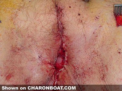 charonboat_dot_com_cancer_vulva3.jpg