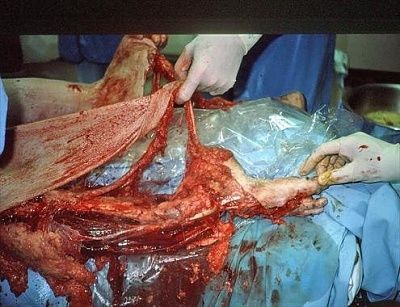 trauma.highvelocitylegtrauma.requiredprimaryamputation.1.jpg