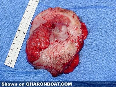 charonboat_dot_com_cancer_vulva4.jpg