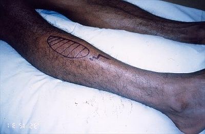 compartmentsyndrome.1playedcricket8hrs.pain-26paraesthesia-26footdroop.pre-op..jpg