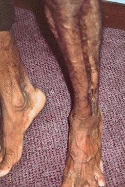 Compartmentsyndrome.5Fasciotomy.Playedcricket8hrs.22yoM.AbletowalkNOTrun.jpg