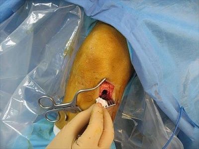 fx.latplatfx.reduced.applybonegraft.herevitoss.1.jpg