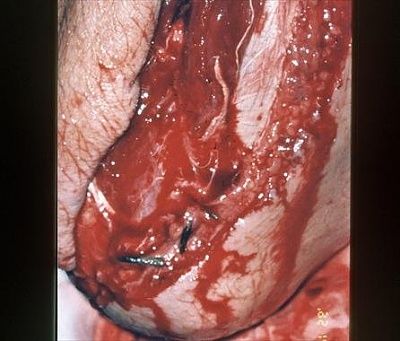 fx.openfxarm.lawnmowerinjury.highincidenceinfection.notewoundorganicdebris.2.jpg