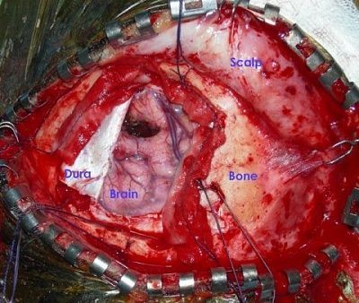 photo-20of-20surgery-20on-20a-20brain-20tumor-20with-20parts-20of-20the-20head-20labelled..jpg