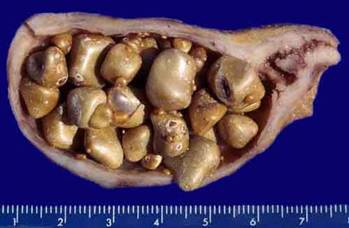 gallstones.jpg