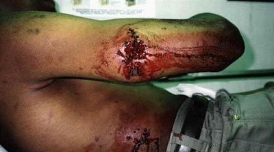glaser-20safety-20slug-20wounds.jpg