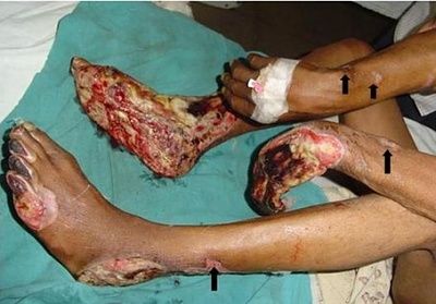gangrene.jpg
