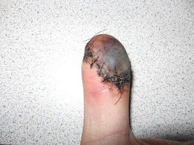saw-20wound.jpg