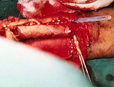 phalloplasty4.jpg