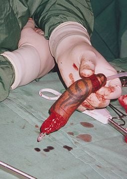 Radial Forearm Free-Flap Phalloplasty: Tattooed Penis - Screen%20shot%202012 08 06%20at%2011 47 37%20AM