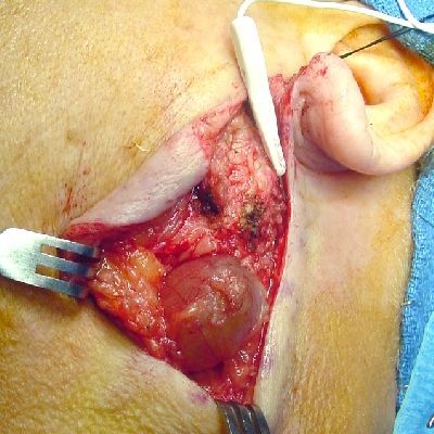 Parotid_Cyst_400_SQ.jpg