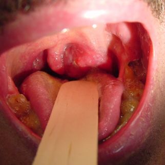 Name:  TONSILLAR_CARCINOMA_001.jpg
Views: 2086
Size:  18.3 KB