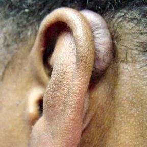 AuricleKeloid2.jpg