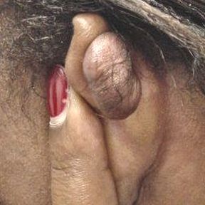 AuricleKeloid3.jpg
