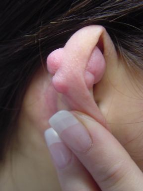 Keloid_3.jpg