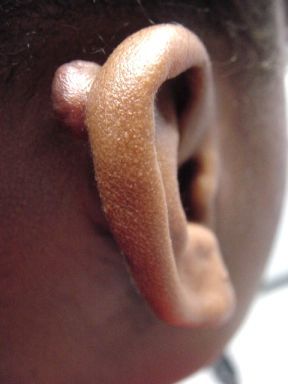Keloid_June14.jpg