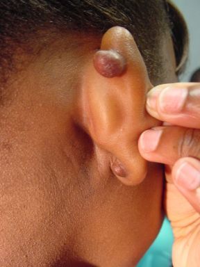 Keloid_June14_017.jpg