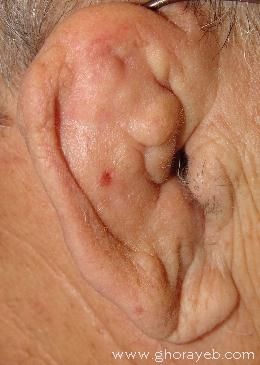 Cauliflower_Ear_360x265_20April05_008.jpg