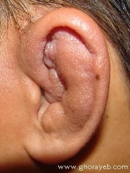 CAULIFLOWER_EAR_22006_066.jpg