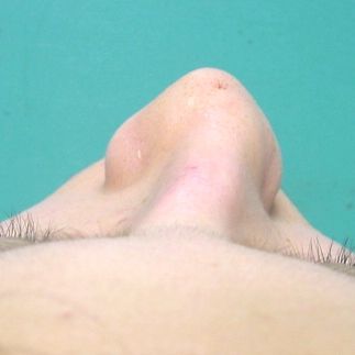 nasal_fx_oct11_014.jpg