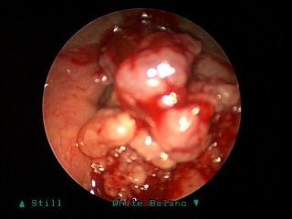 Name:  Larynx_Cancer_Transglottic_a__12_.jpg
Views: 518
Size:  51.6 KB