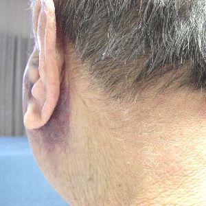 Hematoma_of_Parotid__300SQ.jpg