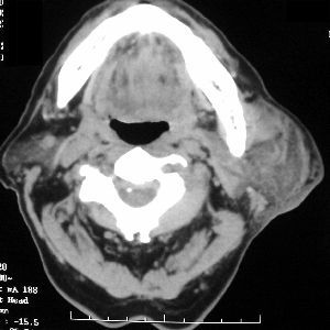 Hematoma_of_Parotid_CT_Axial_300SQ.jpg