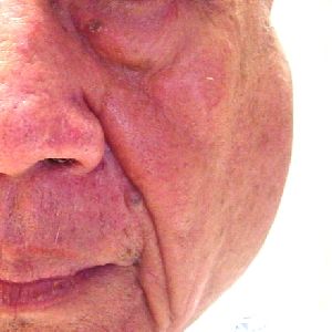 Hematoma_of_Parotid_Face_300SQ.jpg